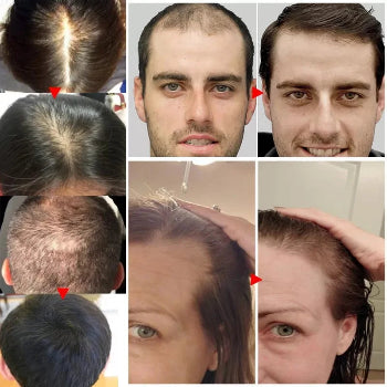 Biotin Fast Hair Growth Oil  Regrowth Serum  Thinning Treatment  c Liquid Anti=- Loss for Women & Men