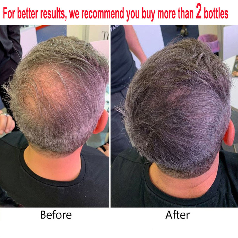 Biotin Fast Hair Growth Oil  Regrowth Serum  Thinning Treatment  c Liquid Anti=- Loss for Women & Men